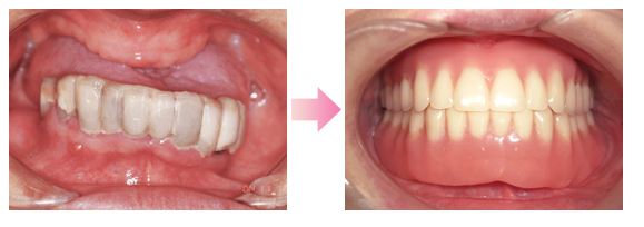 義歯・入れ歯の症例