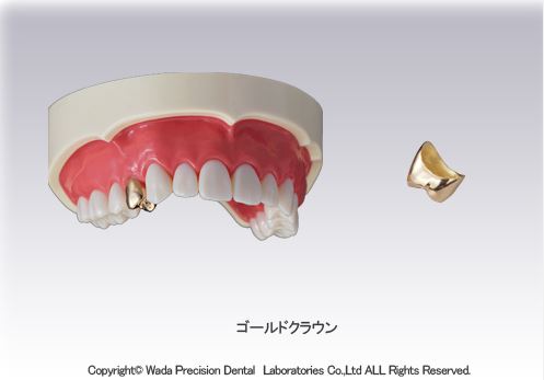 金属のクラウン スタンダードタイプ（自費）