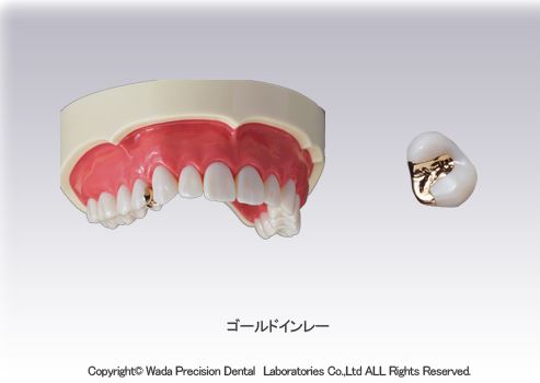 金属のインレー スタンダードタイプ（自費）