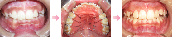 症例2．上顎前突の治療例