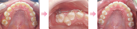 症例3．部分的に歯が器に入れない症例