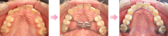 症例3．部分的に歯が器に入れない症例