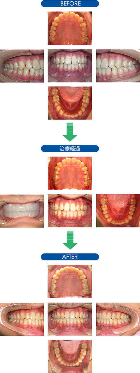 SH療法のよる治療法