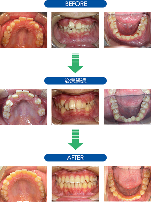 SH療法のよる治療法