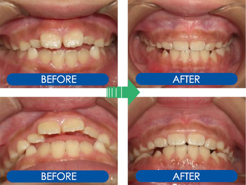 歯科 矯正 ビフォー アフター