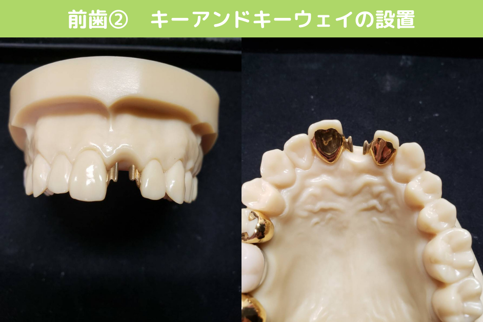 前歯002_キーアンドキーウェイの設置