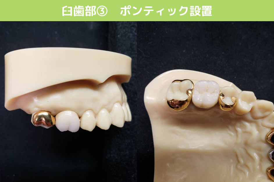 臼歯部003_ポンティック設置